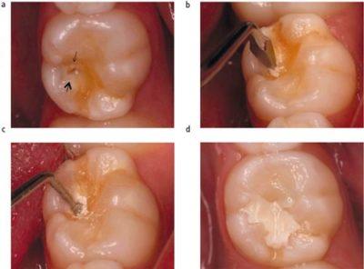 Restorative treatment model image