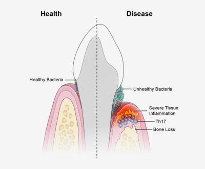 Bacteria and Periodontal Disease image