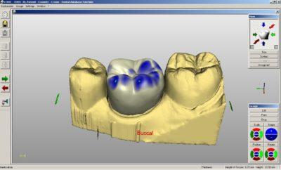 Zirconia CAD/CAM Systems