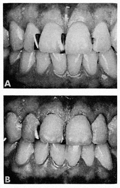 GINGIVITIS IN HUMANS image