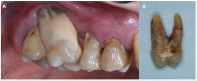 Periodontitis image