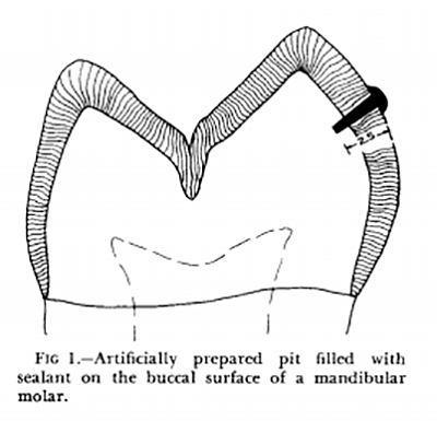 Pit and Fissure Sealants