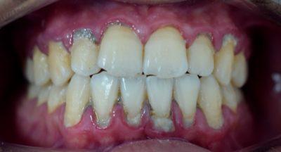 Dental Plaque image